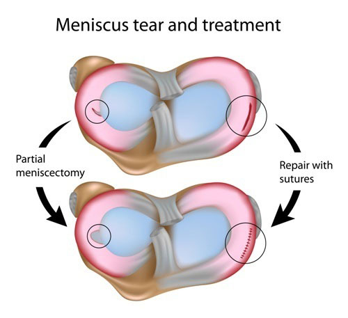 Partial Meniscectomy