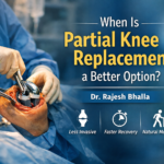 When Is Partial Knee Replacement a Better Option?
